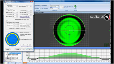 KERATOCONUS